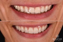 facetas dentárias Casos Clínicos