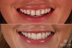 facetas dentárias