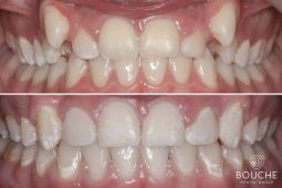 Orthodontie orthodontics ortodontia Casos Clínicos