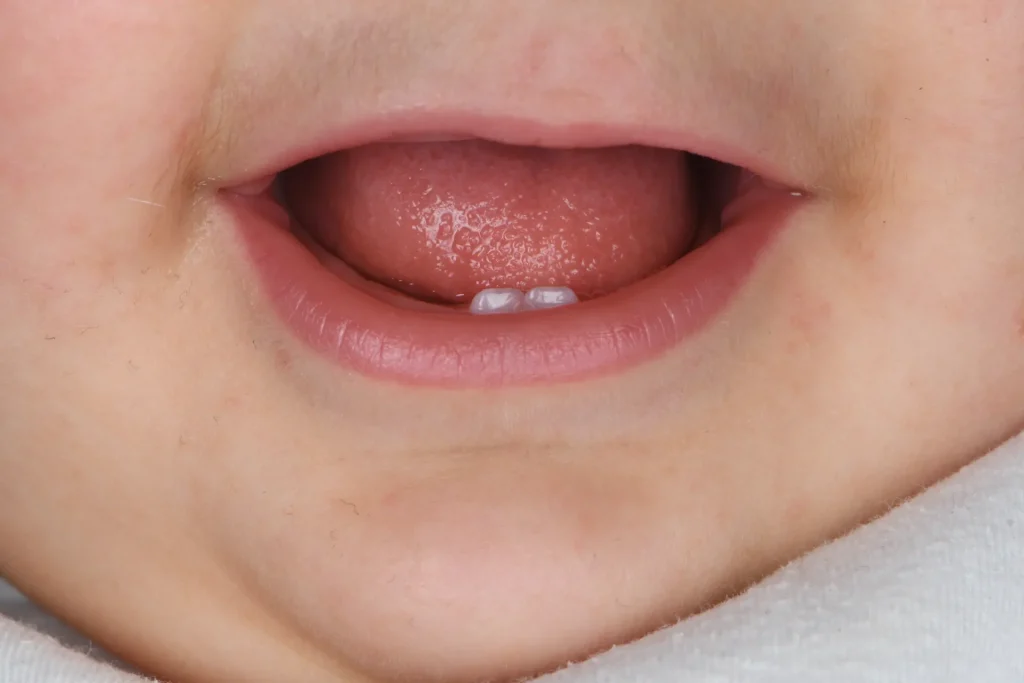 Image showing the eruption of milk teeth in infants