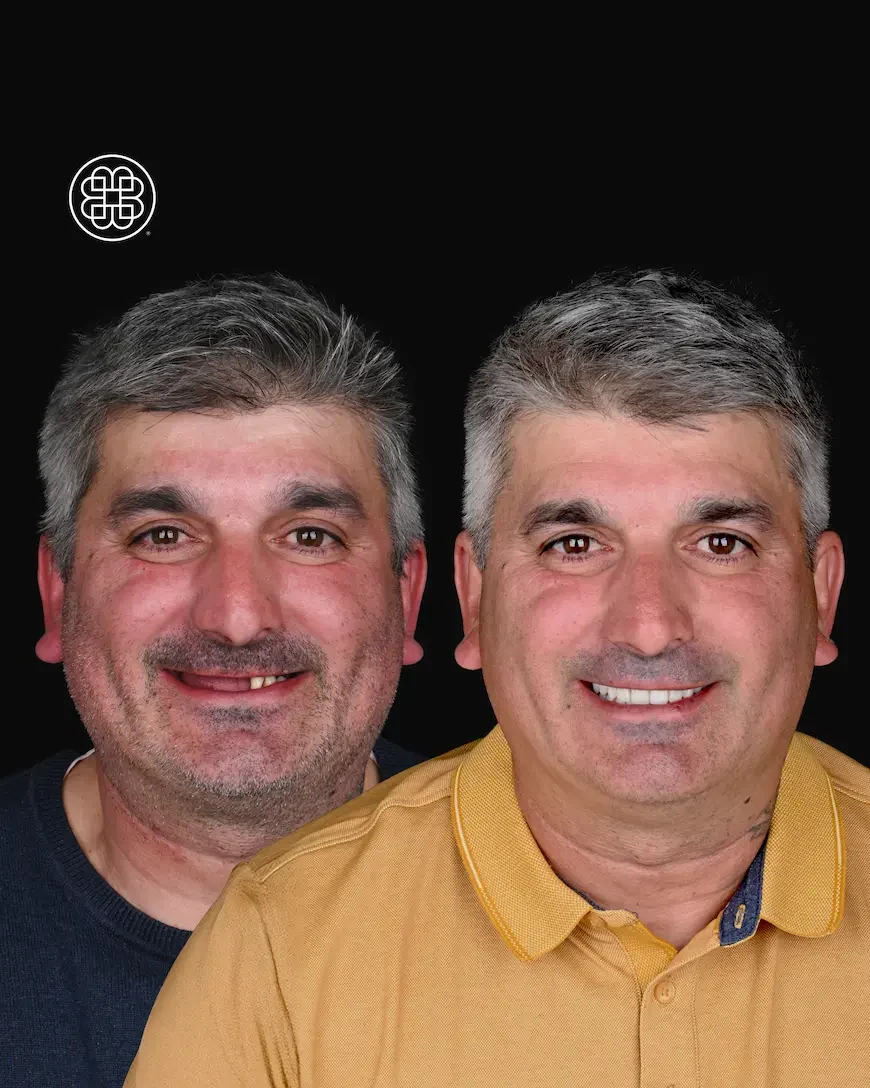 Teeth in 1 day - Bouche Dental Group
