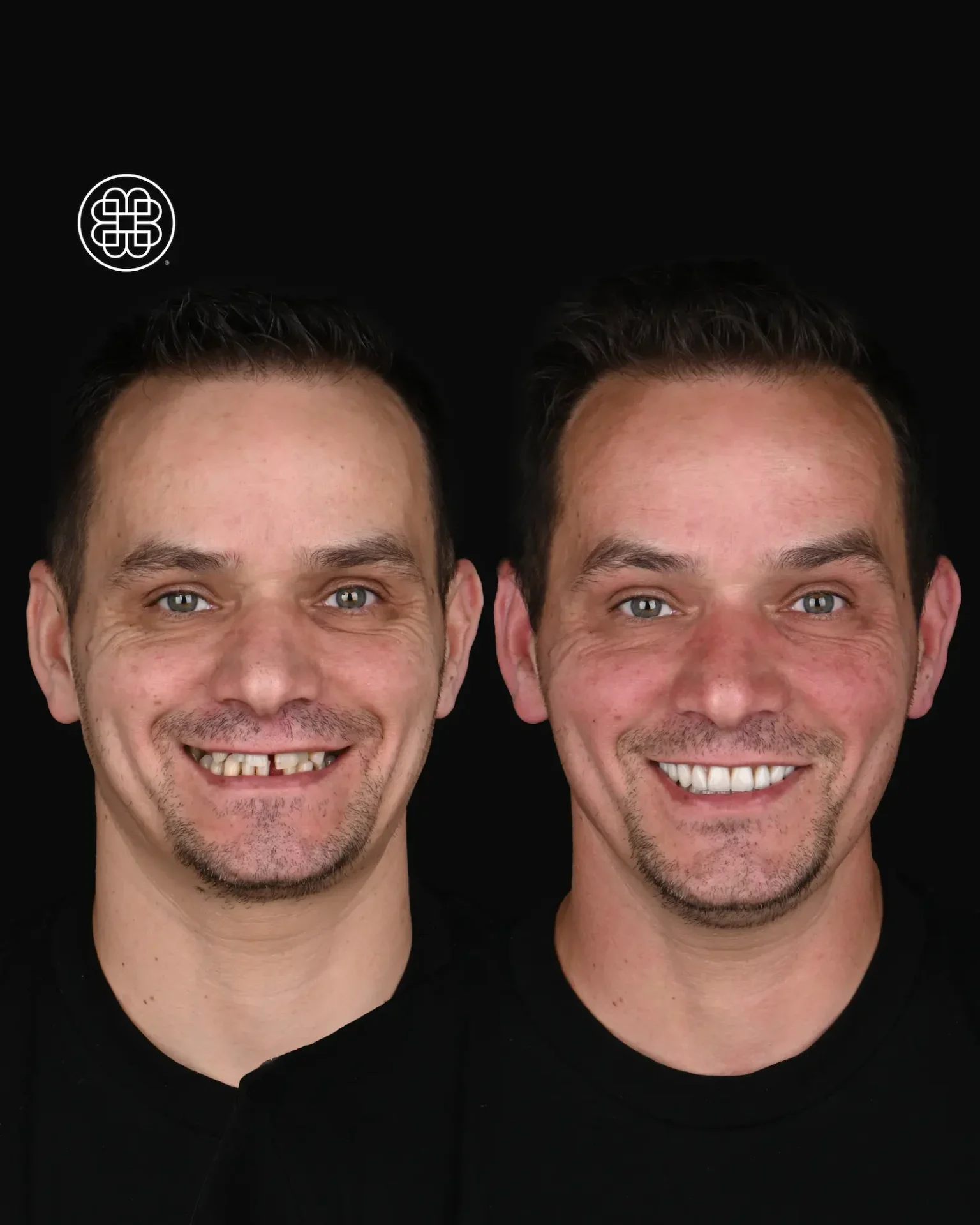 Periodontal Treatment Luxembourg - Bouche Dental Group A 1