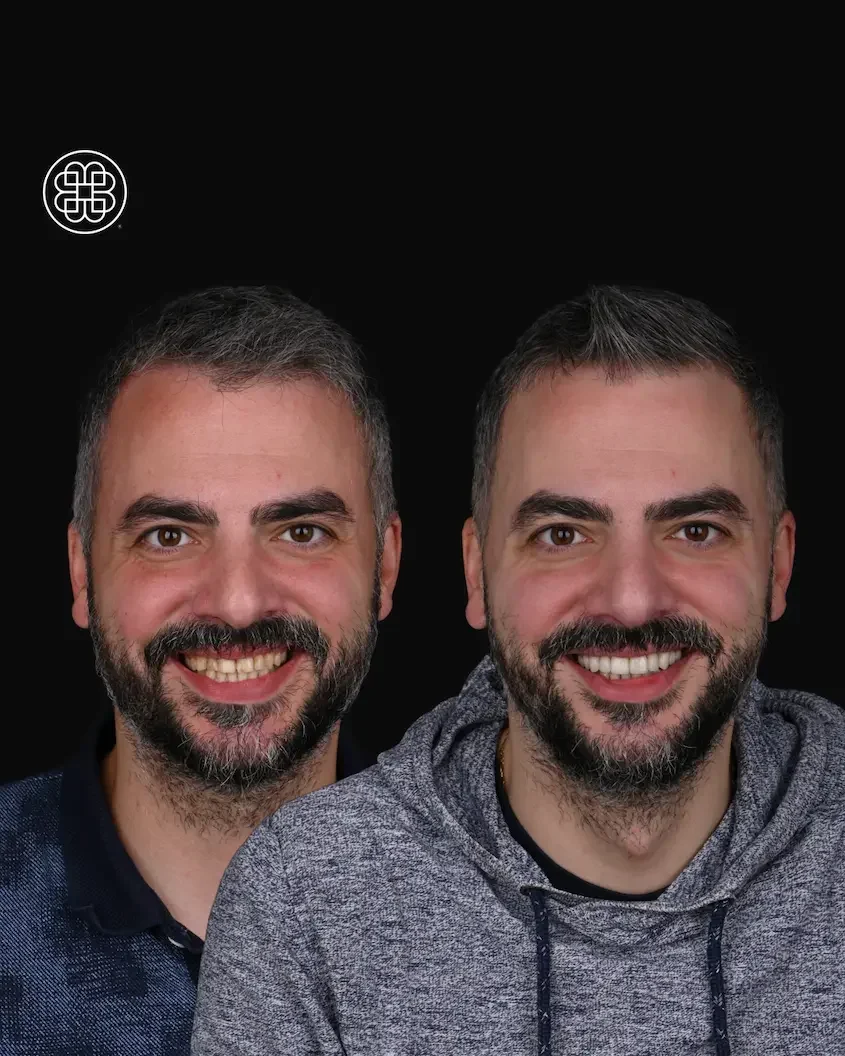 Veneers Luxembourg Bouche Dental Group 1