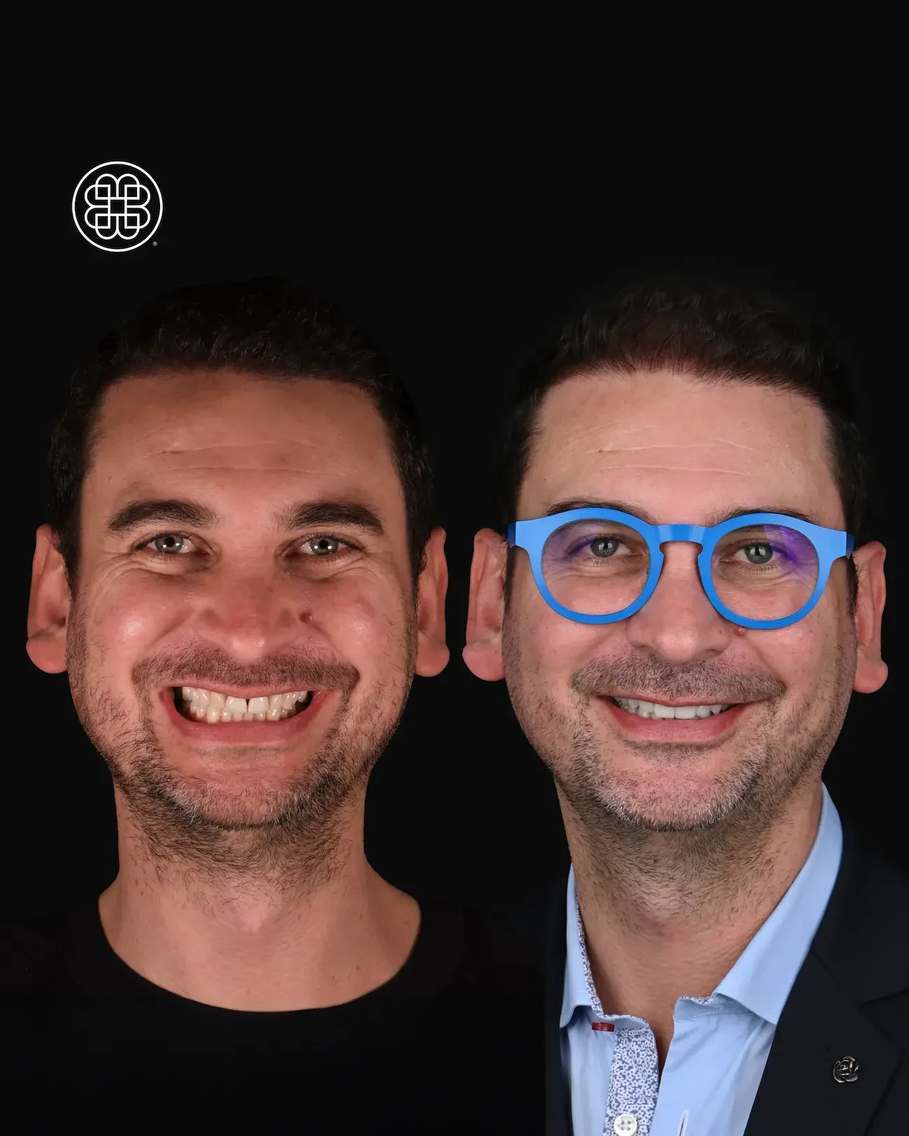 Veneers Luxembourg - Bouche Dental Group j