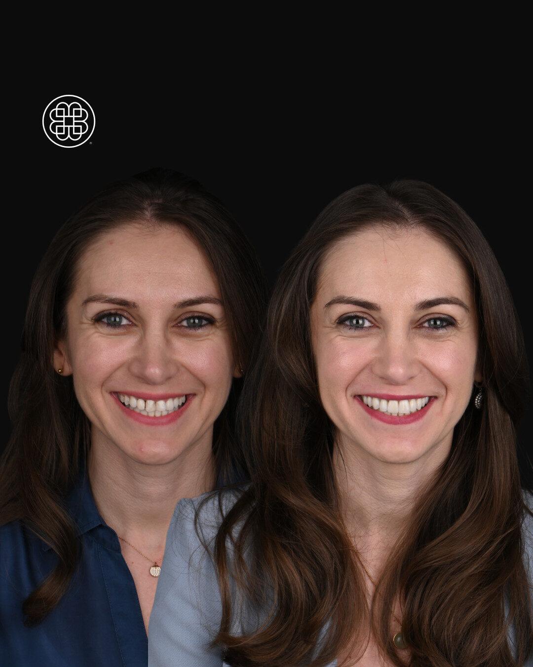 Carrosel JT VENEERS – 2