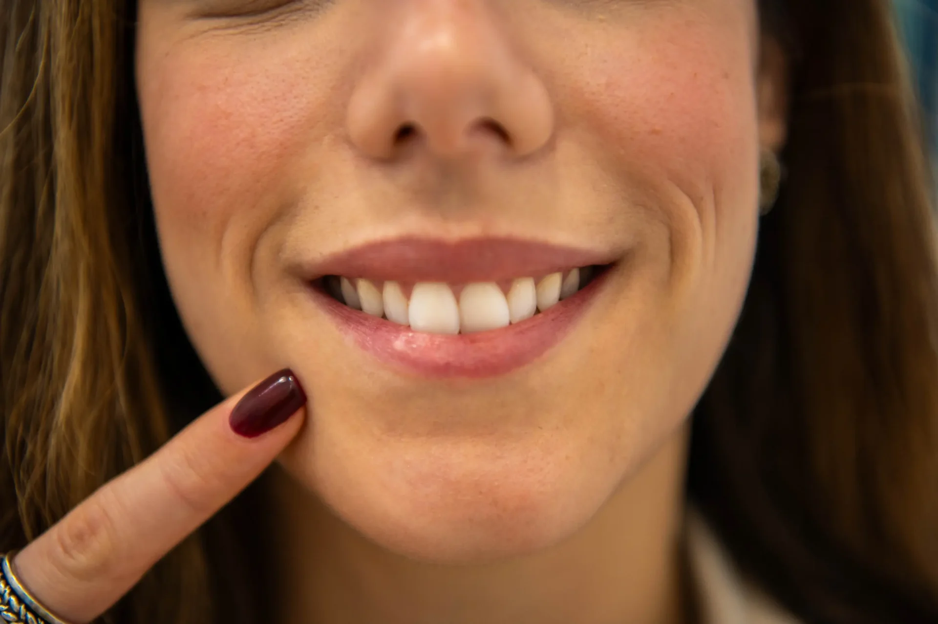 Veneers vs orthodontic treatment