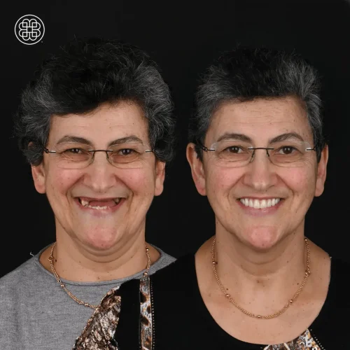 All-on-4 implants smile makeover: before and after photos.