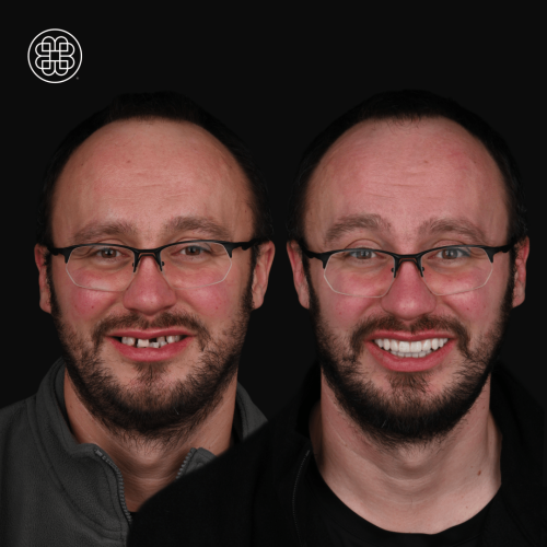 Teeth in 1 day - Bouche Dental Group