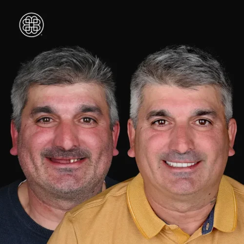 Teeth in 1 day - Bouche Dental Group