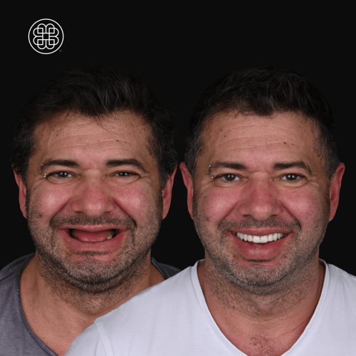 Before and After AO4 BDG