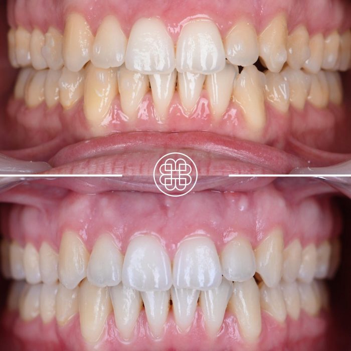 Transformação do sorriso através do tratamento ortodôntico.