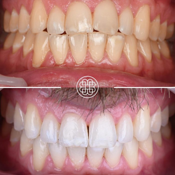 Ortodontia – resultado final comparado com a condição inicial