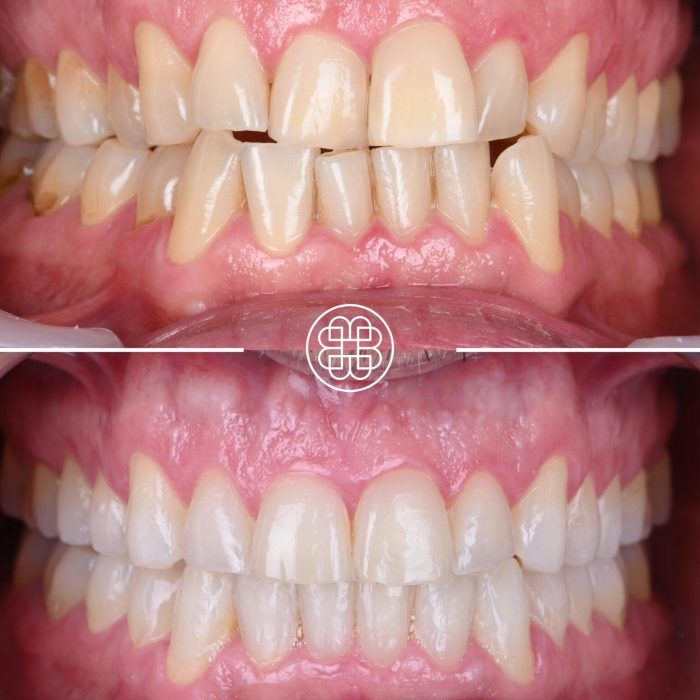 Tratamento ortodôntico – antes e depois do alinhamento dos dentes