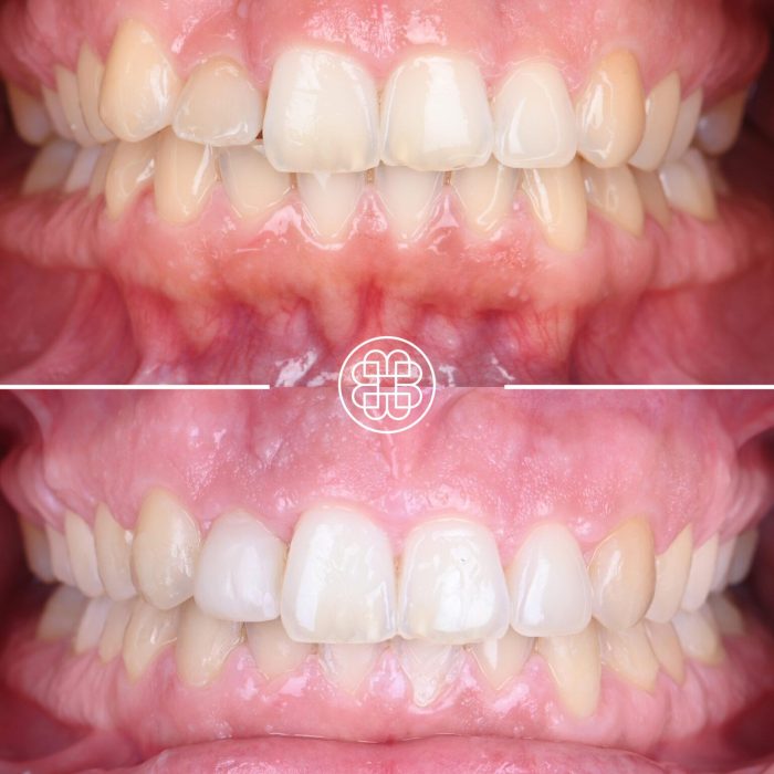 Antes e depois após tratamento ortodôntico