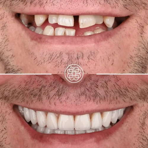 Periodontal treatment end-stage - Luxembourg - Bouche Dental Group