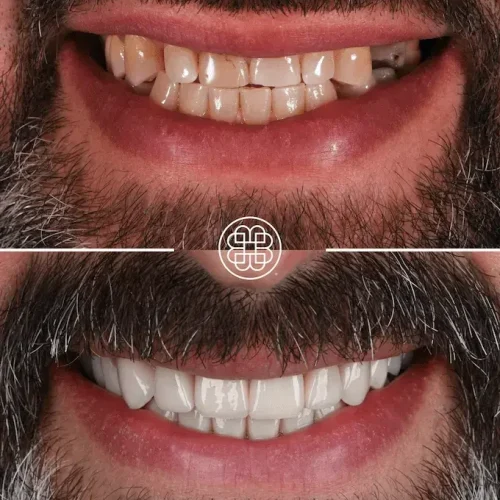 Dental implants Luxembourg - Bouche Dental Group